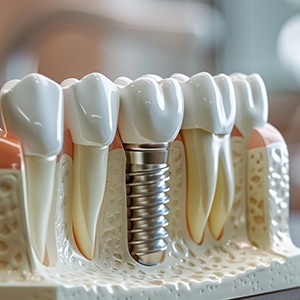 an AI-generated image of a dental implant in a jawbone