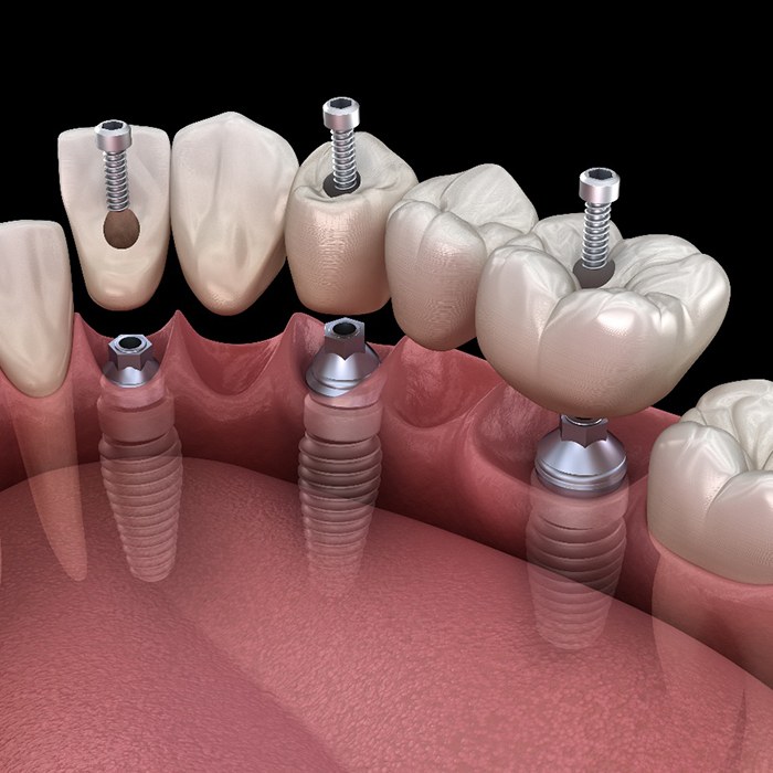 A dental bridge sitting next to various dentistry tools