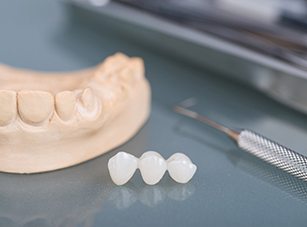 A 3D illustration of a traditional dental bridge
