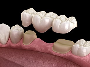 A 3D illustration of an implant dental bridge