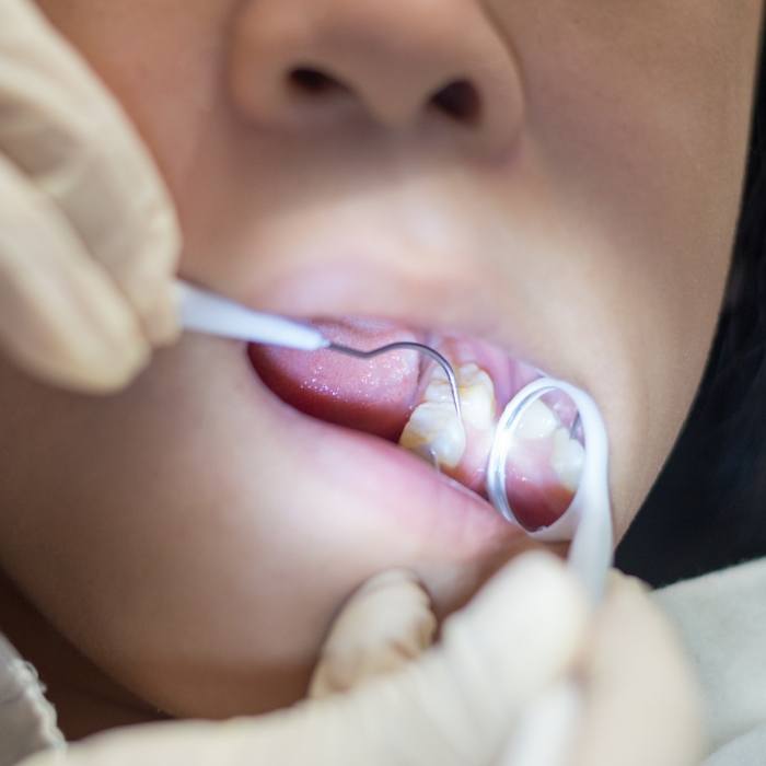 Close up of dental mirror inside mouth during children's dentistry visit