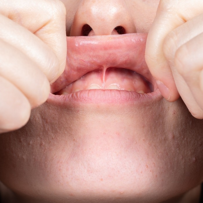 Close up of person stretching their upper lip