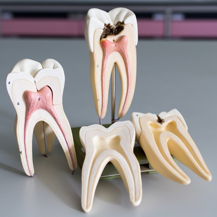 Models of damaged teeth that need pulp therapy