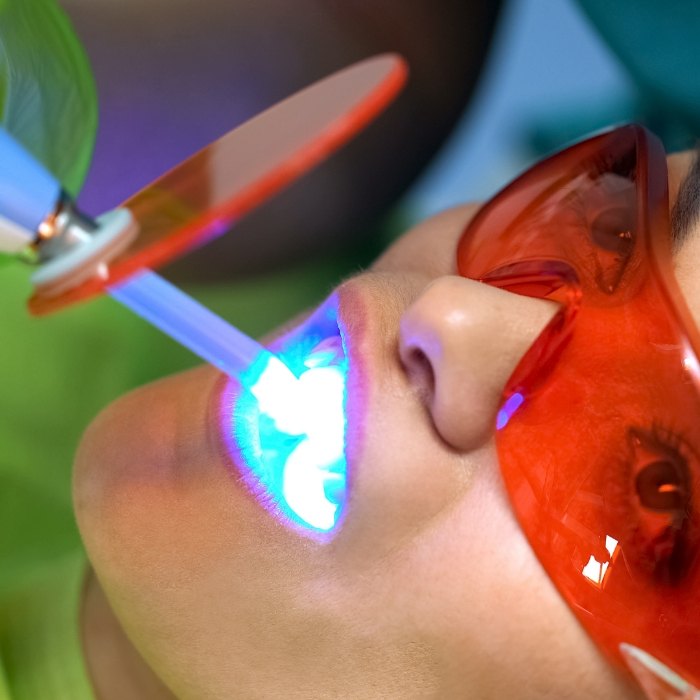 Close up of person getting professional teeth whitening from cosmetic dentist
