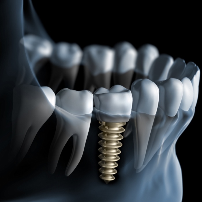Animated X ray of a person with a dental implant in Arlington
