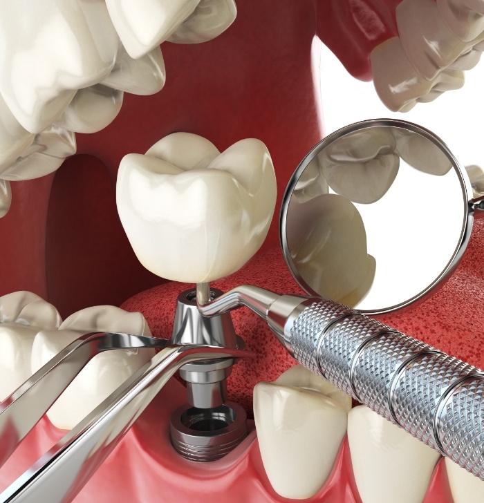 Animated dental implant being placed in the mouth