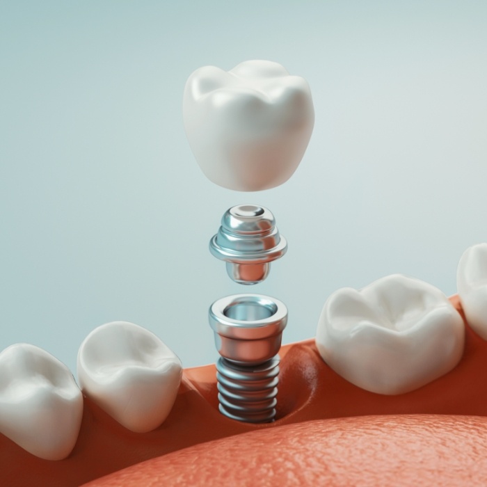 Animated dental implant replacing a missing lower tooth