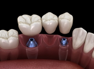 Two dental implants with a dental bridge