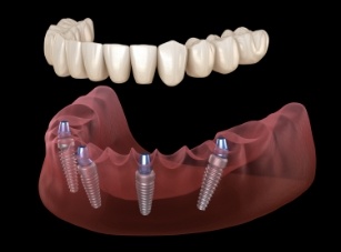 Four animated dental implants with a full implant denture