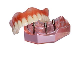 implant denture on table 