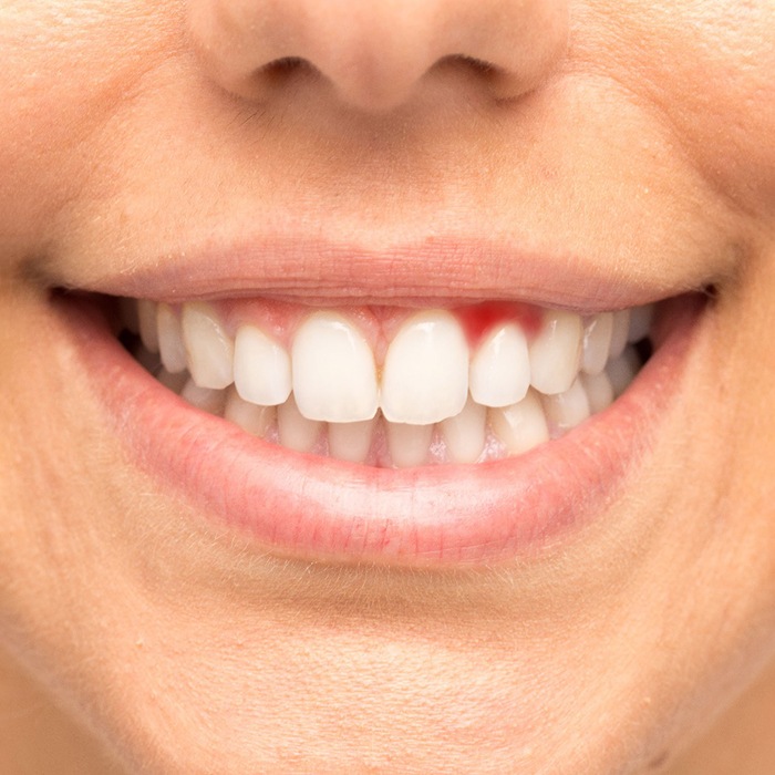 Close-up of smile with inflammation from gum disease in Arlington, TX