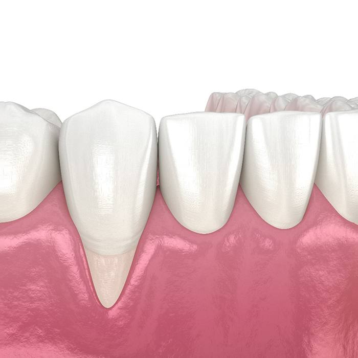 Illustration of gum recession due to gum disease in Arlington, TX