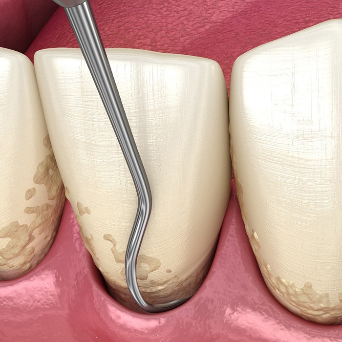 Illustration of scaling and root planing for gum disease in Arlington, TX