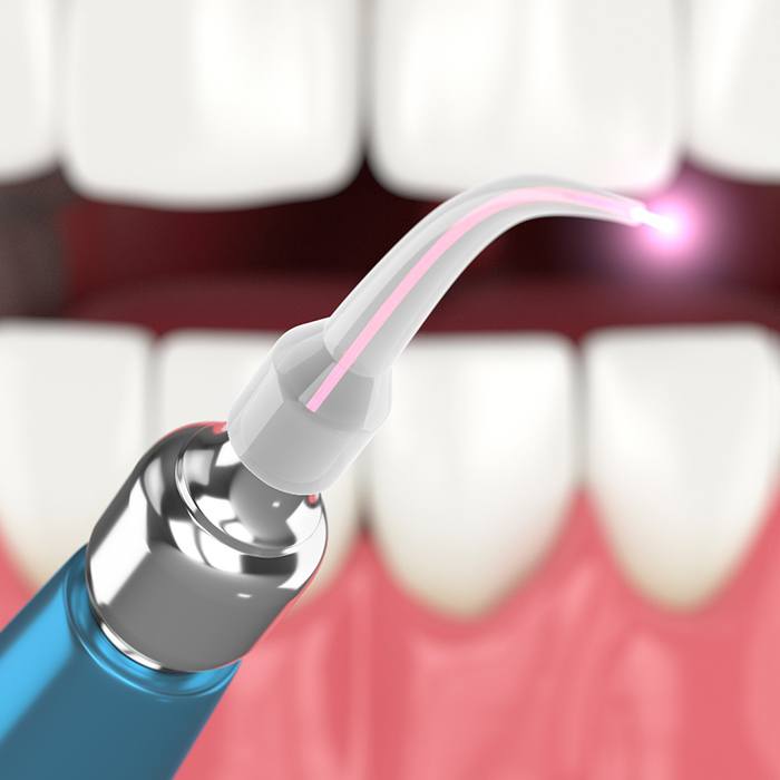 Close-up of smile and a soft-tissue laser