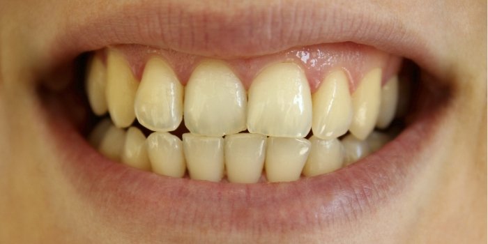 Close up of discolored teeth before treatment from Arlington dentist