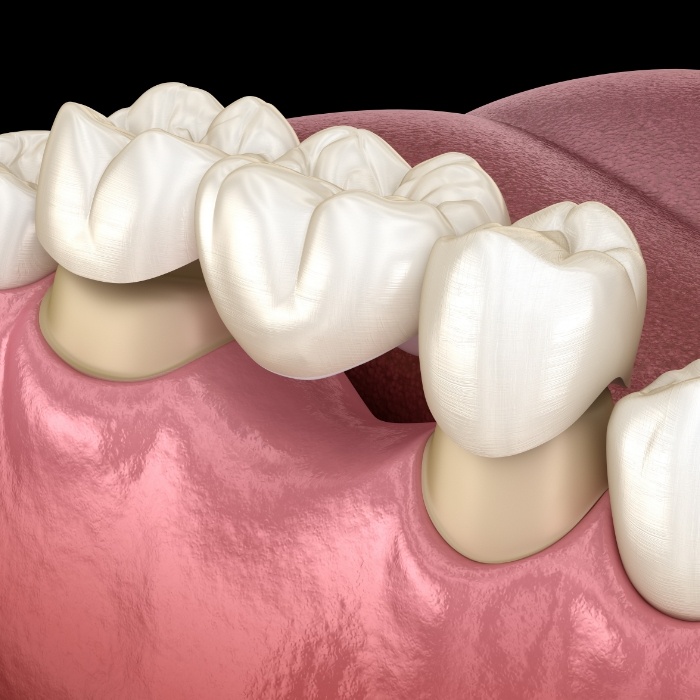 Animated dental bridge replacing a missing tooth