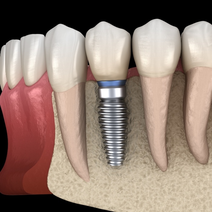 Animated dental implant replacing a missing tooth