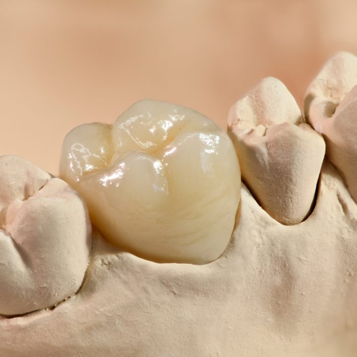 Dental crown on tooth in model of smile
