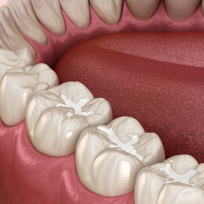 Animated row of teeth with tooth colored fillings