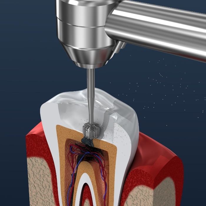Animated diagram of root canal treatment in Arlington