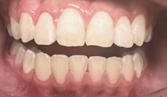 Close up of mouth with straight teeth after treatment from Arlington dentist