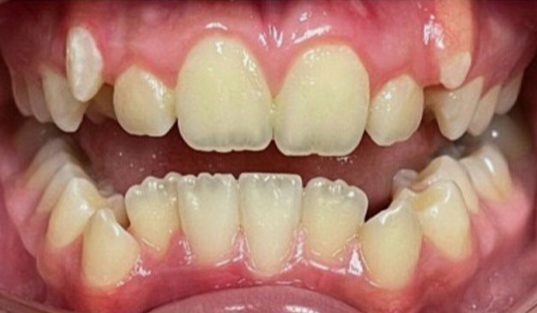 Close up of mouth with misaligned teeth