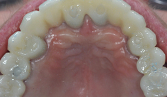 Arch of perfectly straight teeth after orthodontic treatment