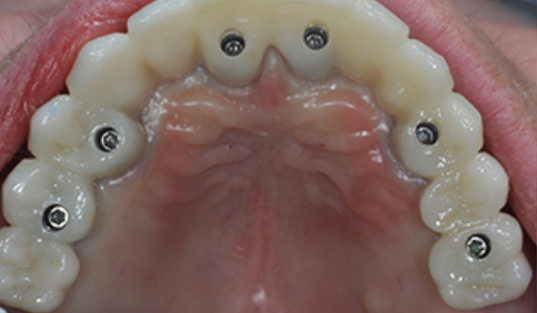Arch of teeth with Invisalign attachments