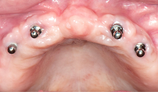 Close up of mouth with a few dental implant abutments