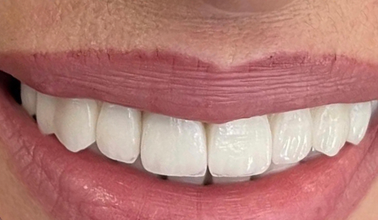 Close up of smile with brand new dental restorations