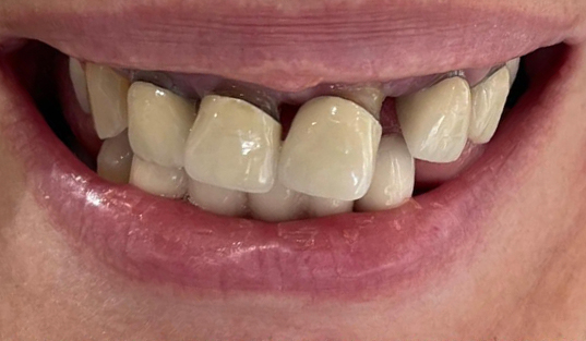 Close up of smile with old dental crowns