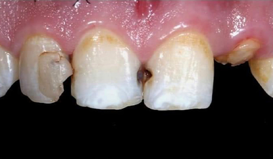 Close up of decayed and broken teeth