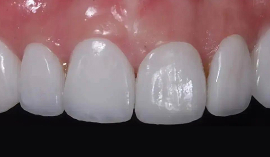 Close up of flawless teeth after dental work from Sonria Dentista of Arlington