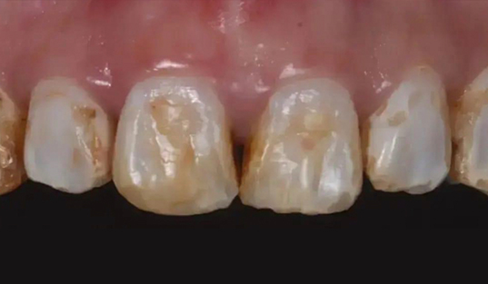 Close up of discolored and broken teeth