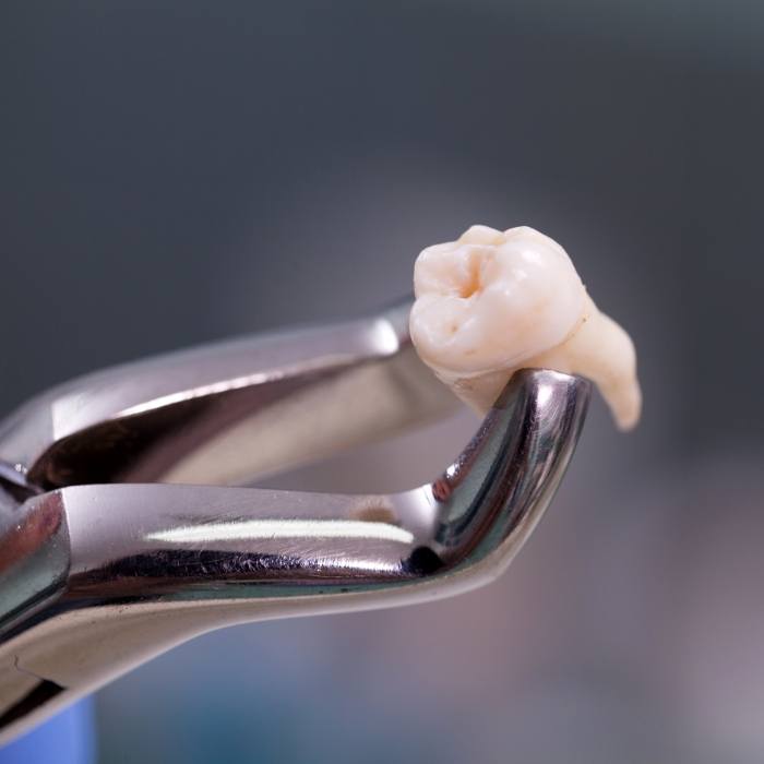 Dental forceps holding a tooth after tooth extraction in Arlington