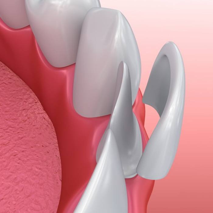 a 3 D illustration of a veneer being placed