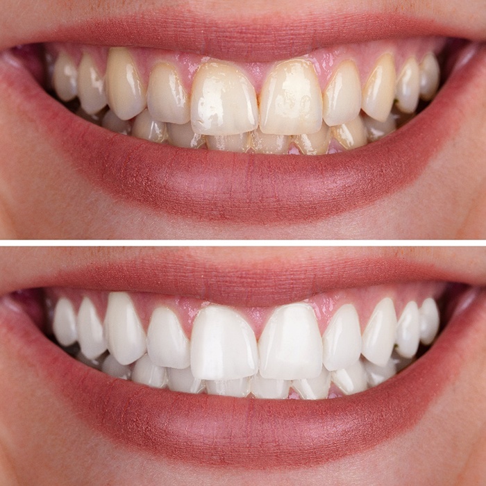 Patient's smile before and after teeth whitening treatment