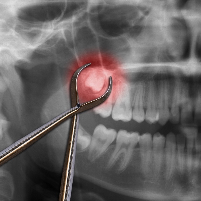 Dental forceps in front of X ray with impacted wisdom tooth highlighted red